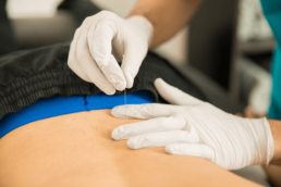 SOW physical therapy | Dry Needling