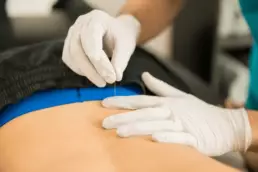 Dry Needling Therapy